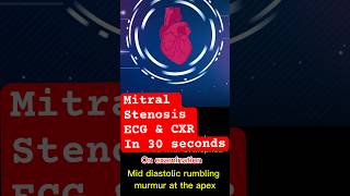 mitralvalve stenosis ecg xray shortnessofbreath cardiology mbbsstudent doctor [upl. by Fonz]