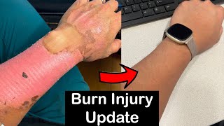 Long Term Healing Progress Of Second Degree Burns 3 Year Update [upl. by Garnes]