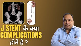 Double J Stent ko nikaalwana bhool gaye ab Kya karein  Dr Amitkumar Jha [upl. by Atiuqcir]