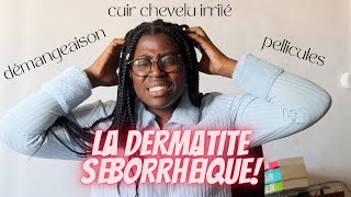 Démangeaison pellicules cuir chevelu irrité  Je souffre de dermatite séborrhéique [upl. by Mello]