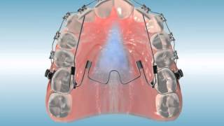 Nitanium® Palatal Expander²™ MultiPurpose Finishing Appliance [upl. by Magdala]