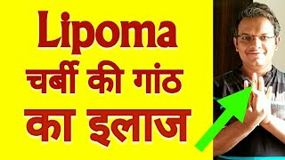 Acupressure Points For LIPOMA  Single Acupressure Point For Lipoma REMOVAL  In Hindi [upl. by Ellirehs]