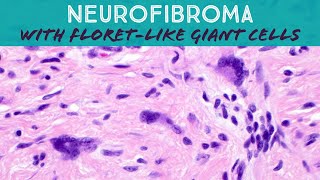 Neurofibroma with floret cells dermpath pathology dermatology [upl. by Hillard]