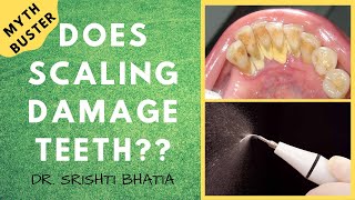 Does SCALING damage teeth क्या दांतों की सफाई दांतों को नुकसान पहुंचाती है Dr Srishti Bhatia [upl. by Hook]