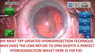 My Updated Hydrodissection Technique Why Does the Lens Refuse to Spin Never Struggle Again [upl. by Elam]