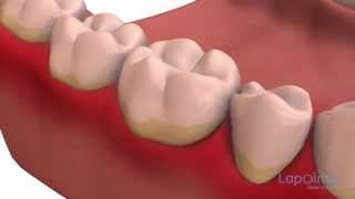 Dental plaque  Lapointe dental centres [upl. by Heinrik]