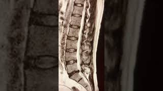 L5S1 Disc herniation radiology shortsviral shortvideo short medical [upl. by Ettennod76]