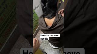 How to remove acupuncture needle drrajni nnc [upl. by Dan]