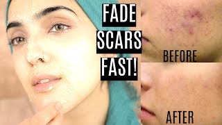 How To Remove ACNE SCARS  HYPERPIGMENTATION Naturally For ALL Skin Types Immy [upl. by Crichton]