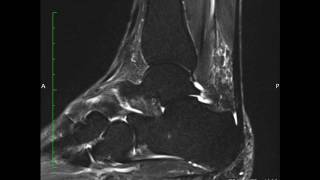 MRI ankle Split Peroneus Brevis Tear [upl. by Atlanta]