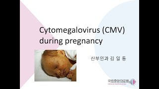 Cytomegalovirus during Pregnancy [upl. by Dnomal514]