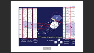 Ventricular tach localisation by ecg VTlocalisation ventriculartachycardia VPC [upl. by Emlynne]