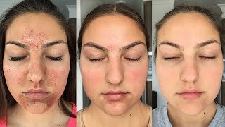 My Accutane Experience  How I Got Clear Skin Before  After Pictures [upl. by Sabina]