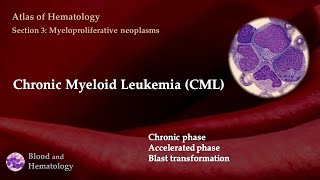 Chronic Myeloid Leukemia CML [upl. by Etnaik]