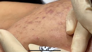 Blackheadsamp Whiteheads Removal On Boy Chin 2024  Acne Treatment Bo Nguyễn Spa [upl. by Gustavus]