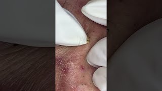 Big Cystic Acne Blackheads Extraction Blackheads amp Milia Whiteheads Removal Pimple Popping shorts [upl. by Elroy]