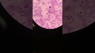 High platelet count platelets clumps  mega platelets  blood smear  mltwithmasood9010 [upl. by Nitaf]