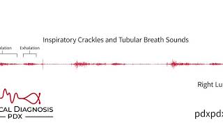 The Lung Sounds of Pneumonia [upl. by Nostets]