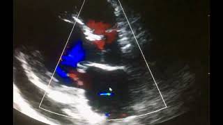 Ecocardiograma Complicaciones del Infarto al miocardio [upl. by Nugent]