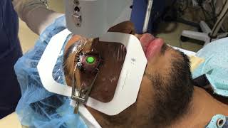 Collagen Cross Linking For keratoconus [upl. by Kalb]