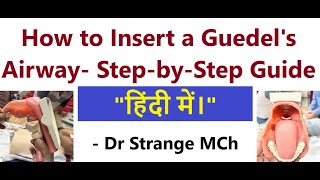 How to Insert a Guedels Airway हिंदी में।   A StepbyStep Guide GuedelsAirway CPR [upl. by Polard]