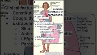 Common features of sarcoidosis [upl. by Mannuela]