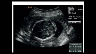 Transverse Cerebellar diameter [upl. by Shawna]