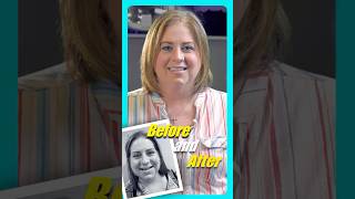 Dental Implants Before and After  Yuba City CA [upl. by Lovett]