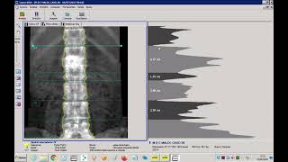 Demonstração de análise de exames de densitometria óssea utilizando software Encore GELunar [upl. by Nirmak]