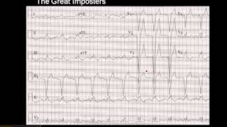 1215 Lead ECG MI Imposter 3 [upl. by Murrah]