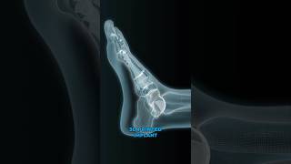 3Dprinted ankle implants 3D Animation [upl. by Ximenez]