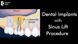 When is a sinus lift procedure done for dental implants  Dr Ranjani Rao [upl. by Kelsy473]