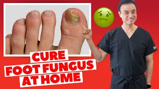 6 Effective HOME REMEDIES To CURE Toenail FUNGUS  Holistic Toenail Fungus Cures Part 2  Dr Kim [upl. by Pettifer4]