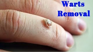 How to get rid of a wart in 1 day  Natural wart removal  How to remove warts on face using garlic [upl. by Abbe]