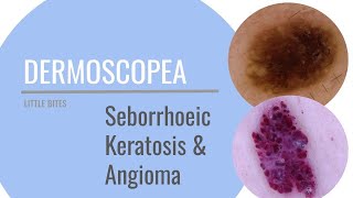 Little Bites  Dermoscopy of Seborrhoeic Keratosis and Angioma [upl. by Reo]