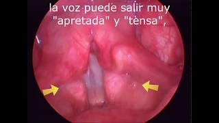 DISFONÍA ESPASMÓDICA ADUCTORA SEVERA ⁣⁣ SEVERE ADDUCTOR SPASMODIC DYSPHONIA [upl. by Adnolohs]