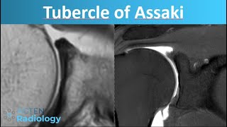 Glenoid variant or pathology  Assakis tubercle [upl. by Noedig]