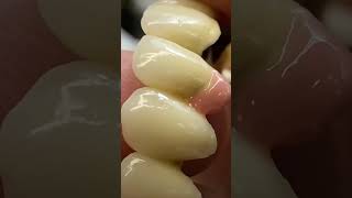 Zirconia bridge viralvideo dentist dentistworld dentalcare dentistryworld dentistry shorts [upl. by Deelaw]