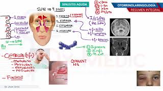 Otorrinolaringología  Sinusitis aguda [upl. by Hogan]