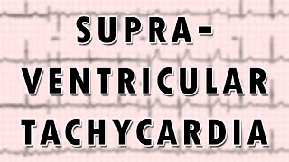 Supraventricular Tachycardia [upl. by Nazay]