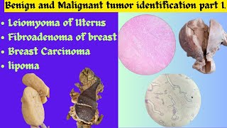 Leiomyoma of Uterus Fibroadenoma of breast Breast Carcinoma Lipoma identificationPatho exam OSPE [upl. by Farica]