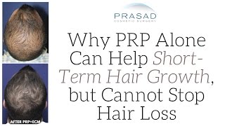 Why PRP Alone Can Help ShortTerm Hair Growth but Cannot Stop Hair Loss Progression [upl. by Eciram999]