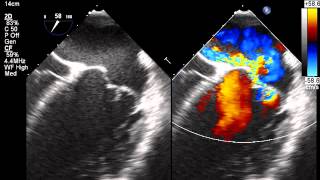 Echo image Leaking mitral valve before keyhole surgery [upl. by Weywadt]