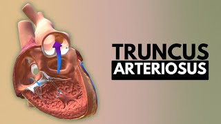 Truncus Arteriosus Causes Signs and Symptoms DIagnosis and Treatment [upl. by Ycinuq711]