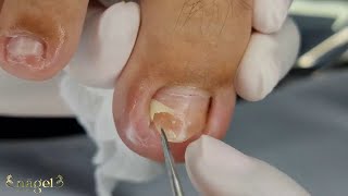 🥺UNHA ENCRAVADA NOS DOIS CANTOS hoje vídeo completo😍 nails ingrowntoenail [upl. by Cand946]