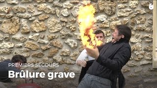 Premiers secours  Brûlure grave  Secourisme [upl. by Seana]