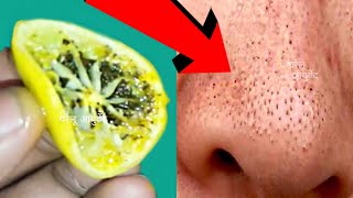 सर्फ 5 मिनट में ब्लैकहेड्स और वाइटहेड्स खत्म करें blackheads amp whiteheads remove fast in 5 minutes [upl. by Rutger]