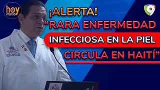 Alerta en Haití por rara enfermedad en la piel  Hoy Mismo [upl. by Aicilram]