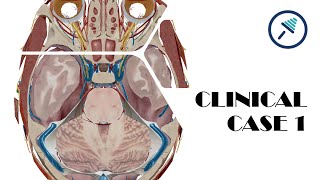 Brain herniations  Case 1 [upl. by Ebberta856]