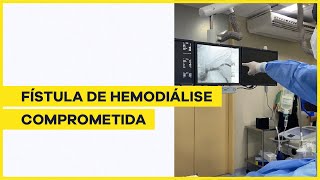 Angioplastia em fístula de hemodiálise [upl. by Namzzaj905]